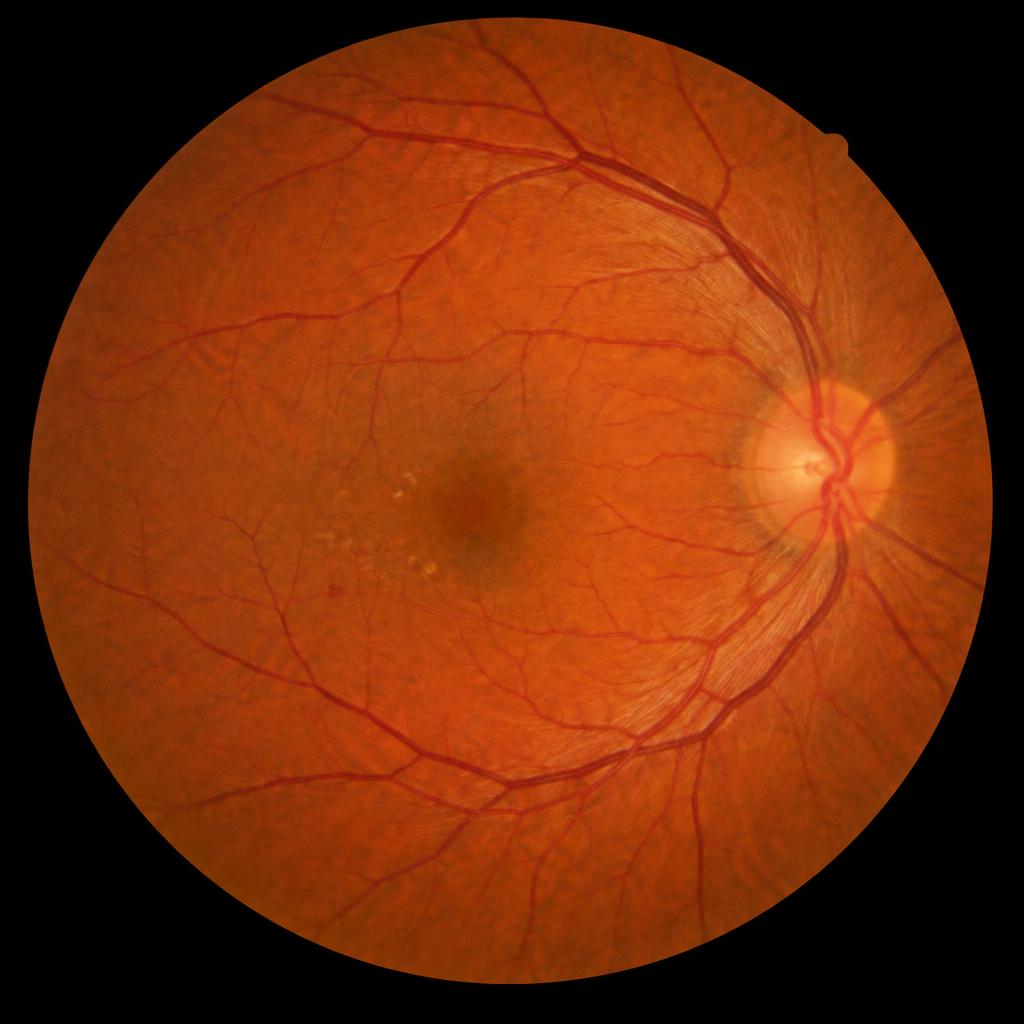 Retina: pilot example image